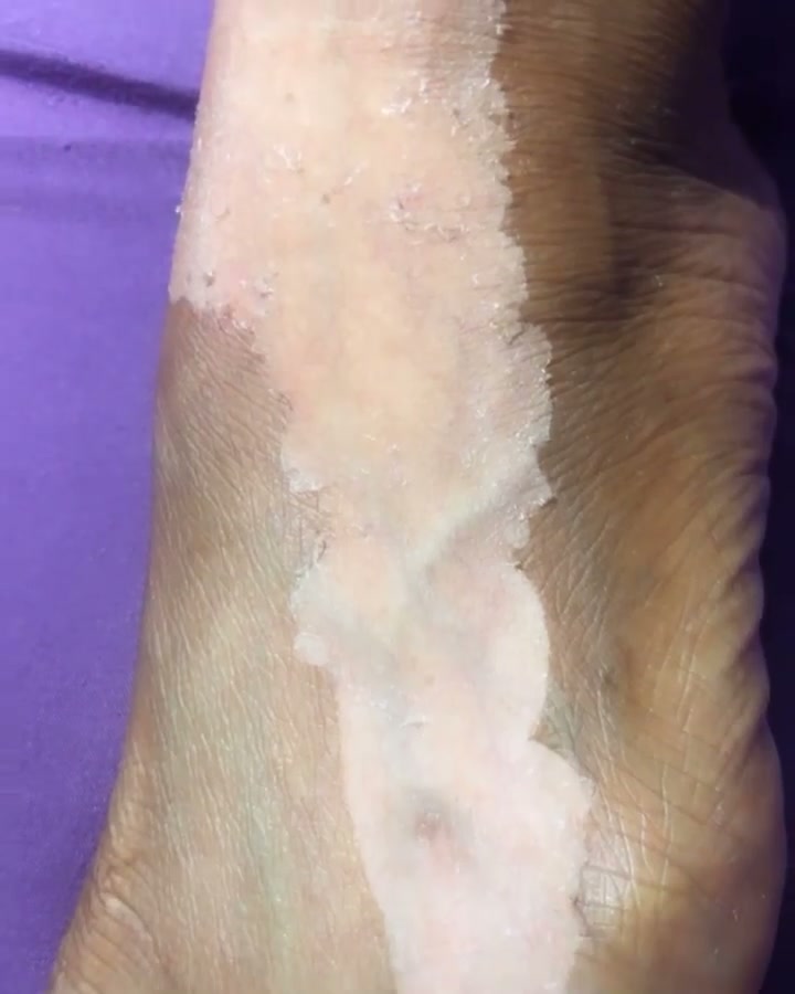 Peel progress three