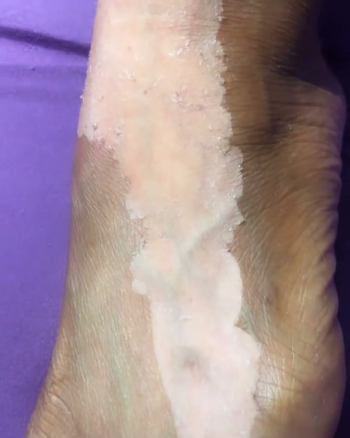 Peel progress one